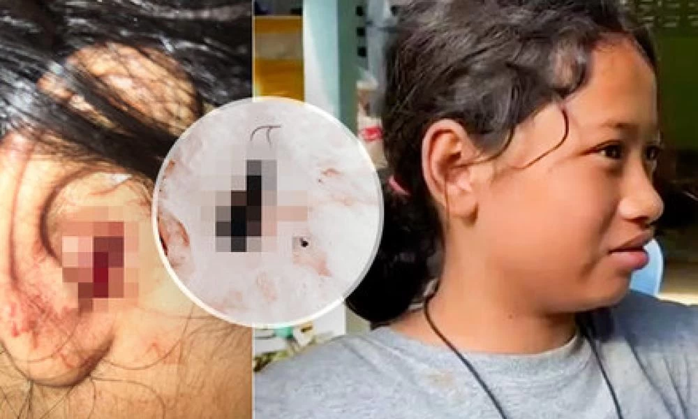 Δυο μέρες χρειάστηκαν οι γιατροί για να της βγάλουν έντομο από το αυτί